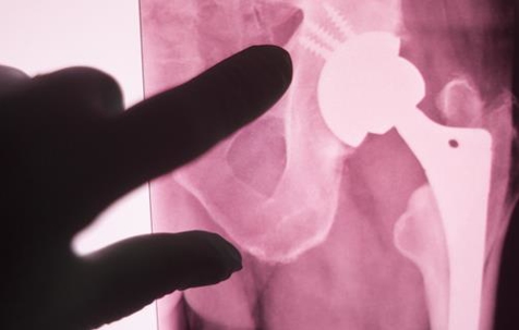 Finger pointing at an x-ray of a hip implant